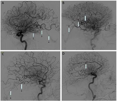 Early Venous Filling Following Thrombectomy: Association With Hemorrhagic Transformation and Functional Outcome